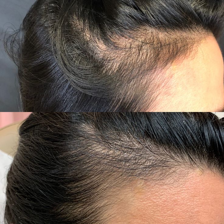 Aceite Batana para el Crecimiento del Cabello – 100 % Natural y Sin Refinar - 118 ml de aceite para el crecimiento y la reparación del cabello | Aceite capilar natural Batana